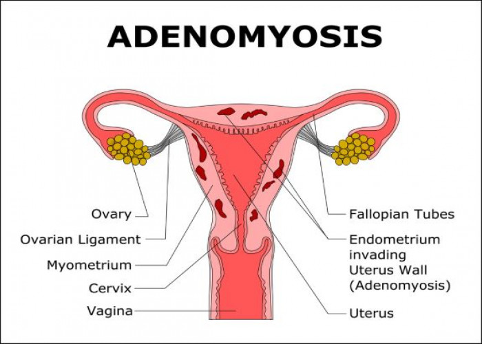 Adenomyosis