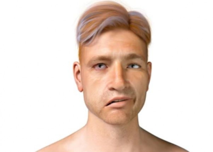 Bell's palsy
