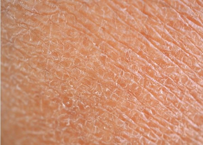 Dry skin