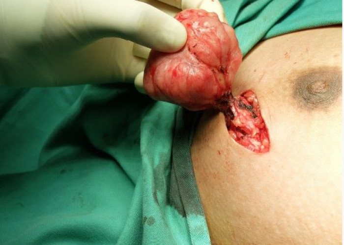 Fibroadenoma