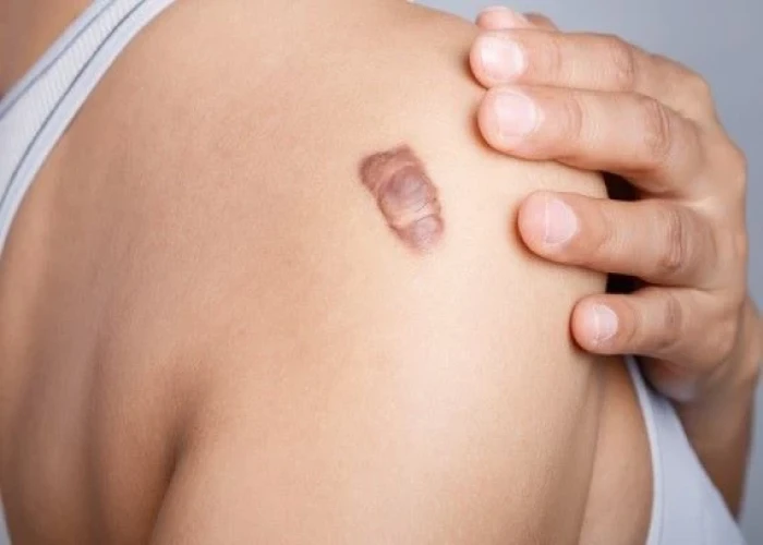 Keloid scar
