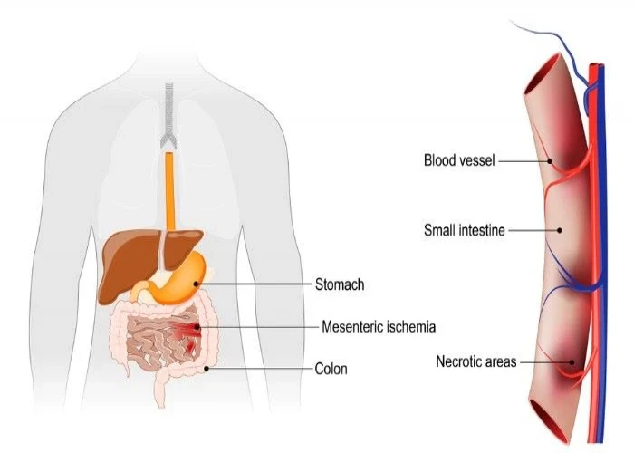 Mesenteric ischemia