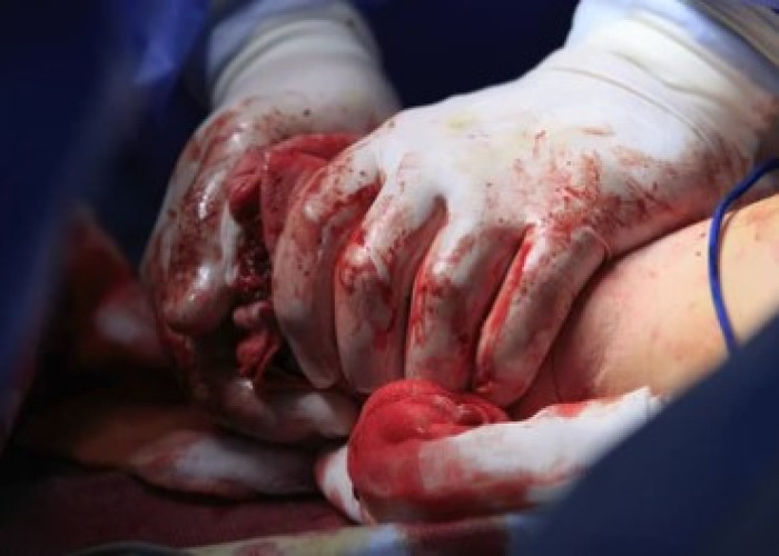 Bleeding