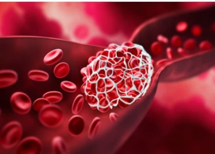 Blood clots in brain