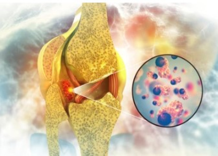 Bone cancer