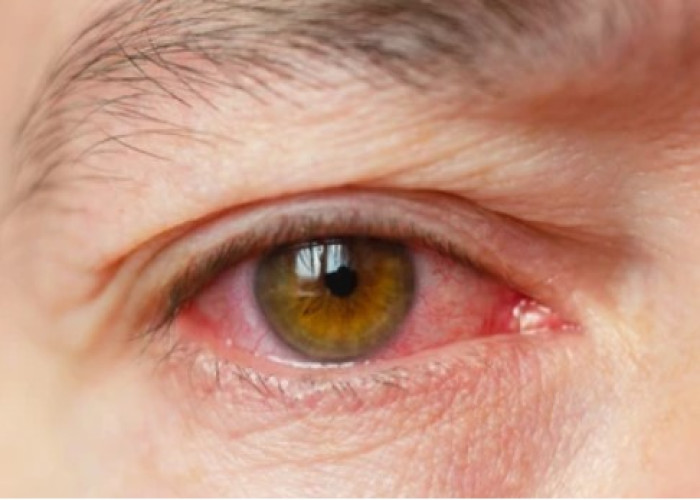 Conjunctivitis