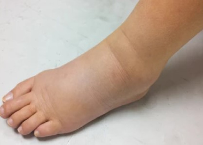 Edema