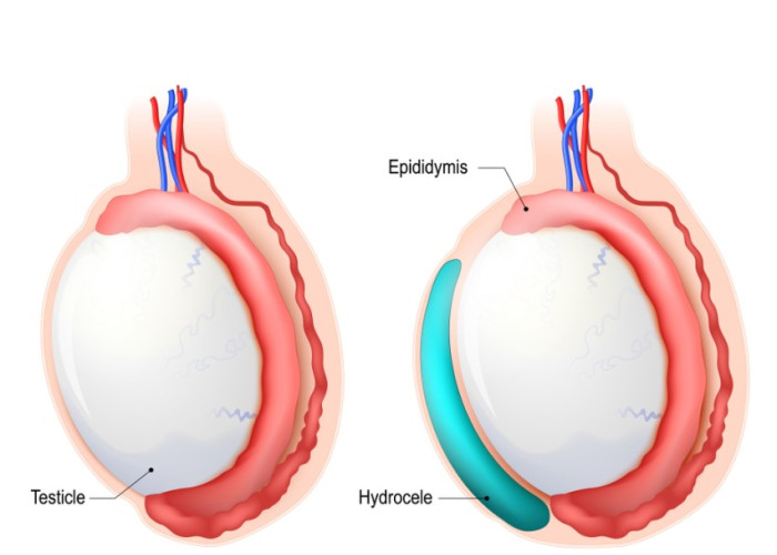 Hydrocele