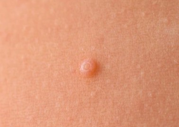 Nodule