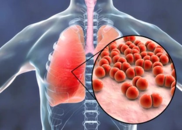 Pneumonia