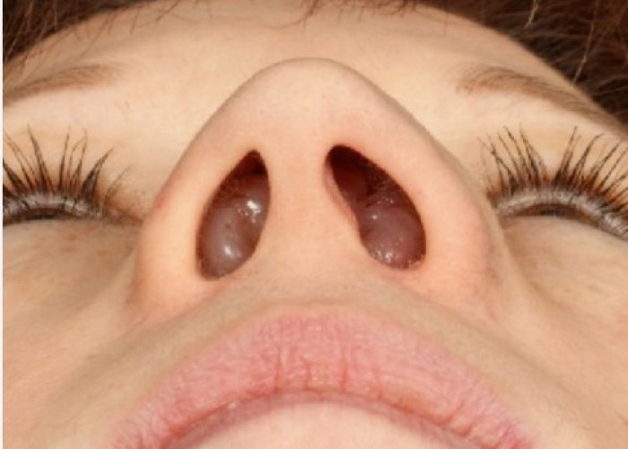 Polypus in nose
