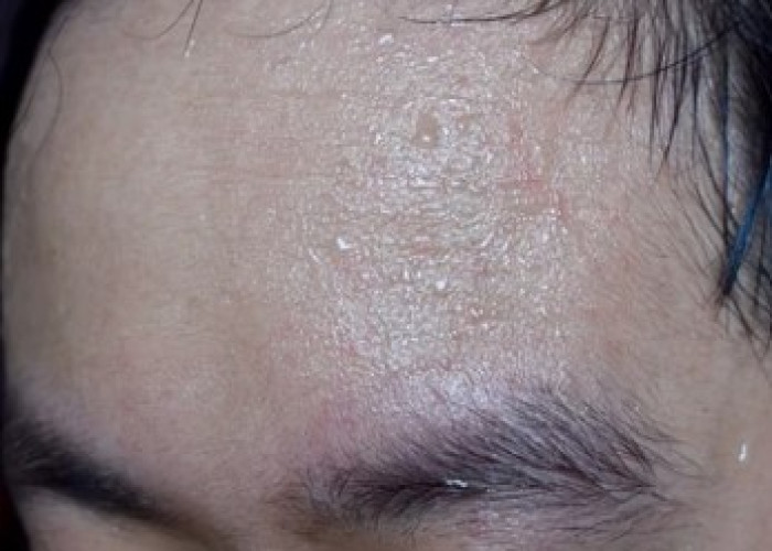 Profuse sweating