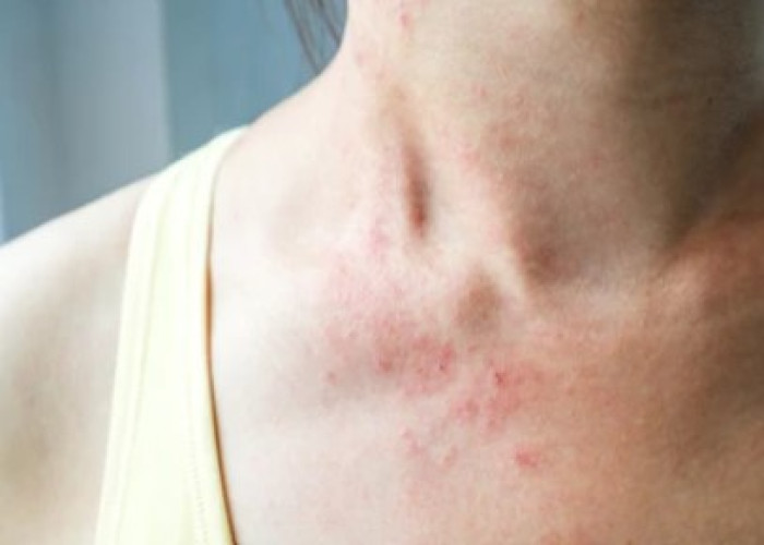 Rash