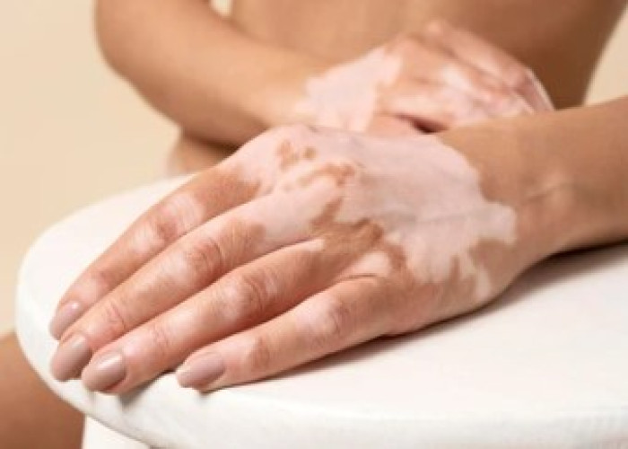 Vitiligo