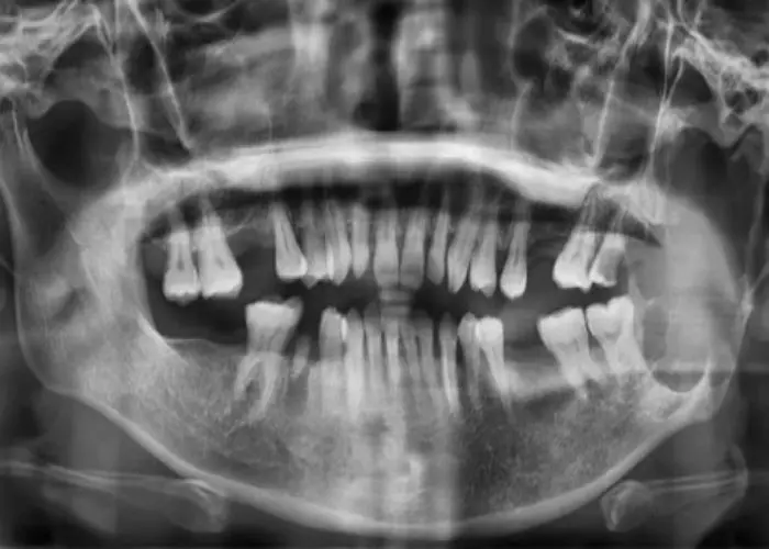 Ameloblastoma
