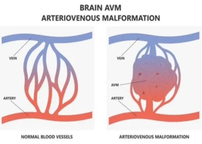 Arteriovenous malformation