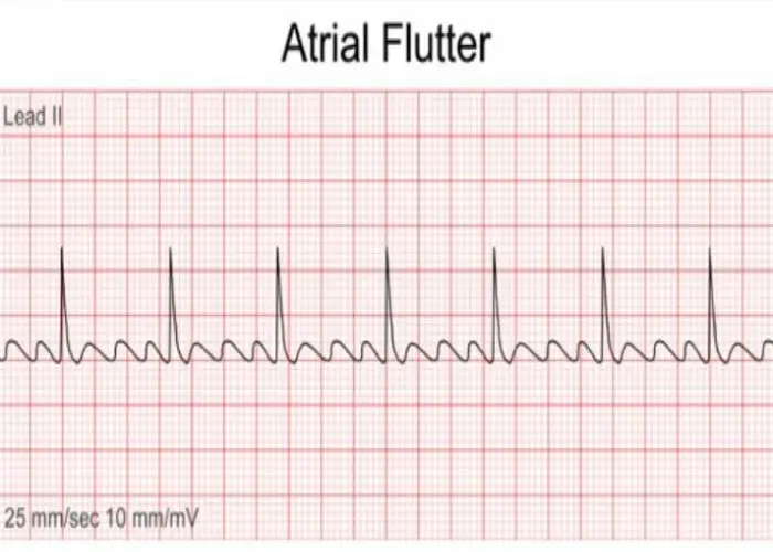 Atrial flutter