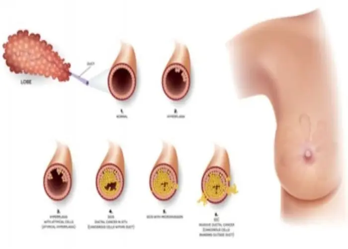 Atypical hyperplasia of the breast