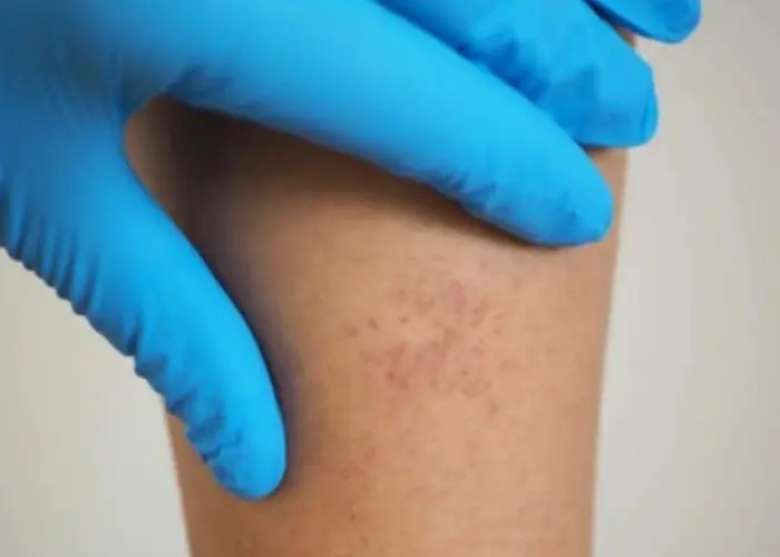 Autoimmune hepatitis