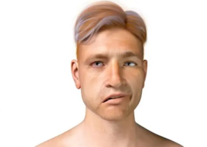Bell's palsy