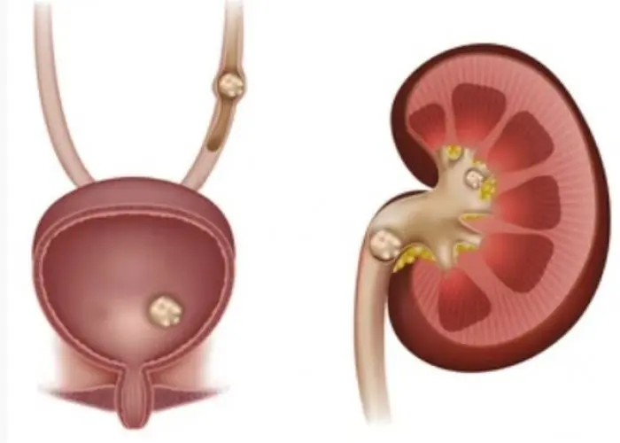 Bladder stones