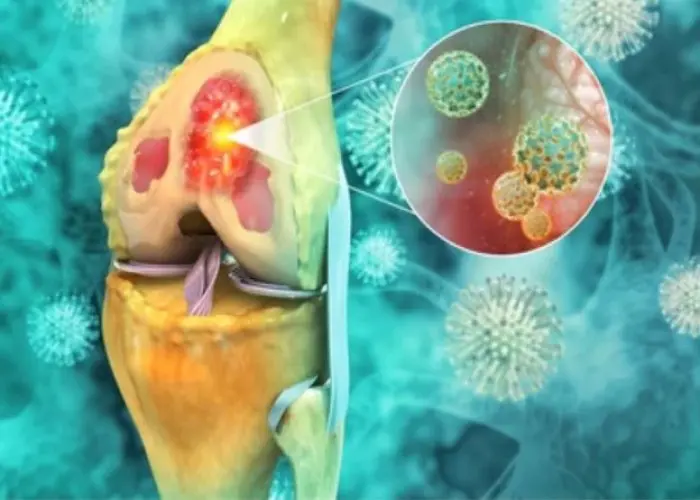 Bone cancer
