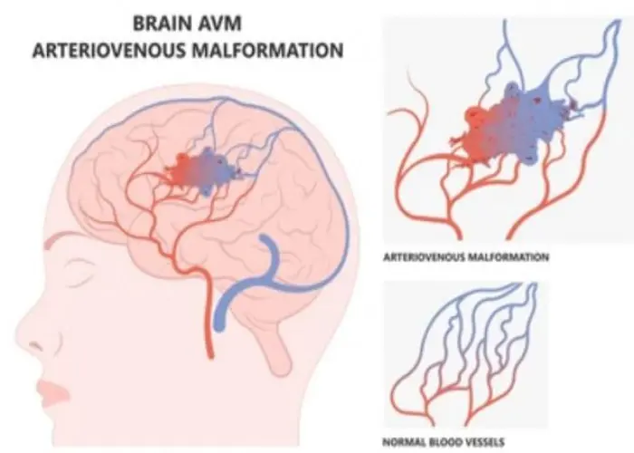 Brain AVM (arteriovenous malformation)