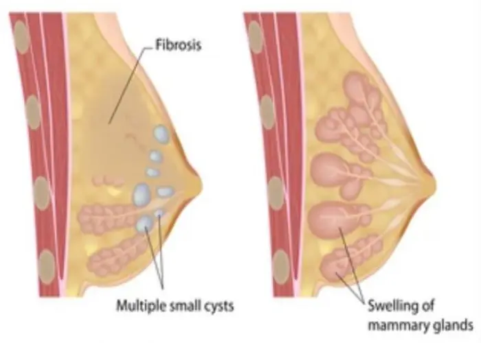 Breast cysts