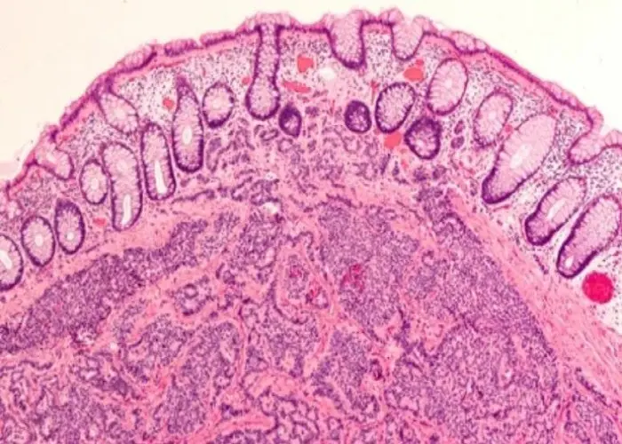 Carcinoid syndrome