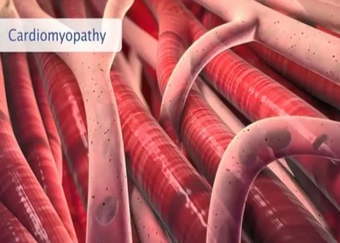 Cardiomyopathy