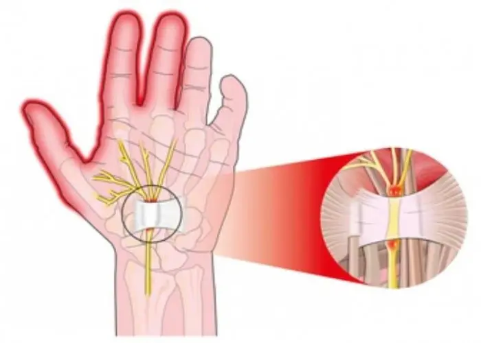 Carpal tunnel syndrome