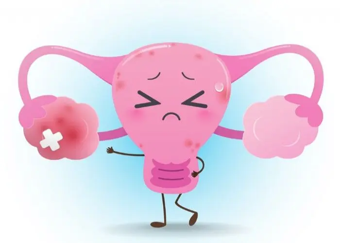 Uterine Inflammation (Cervicitis)