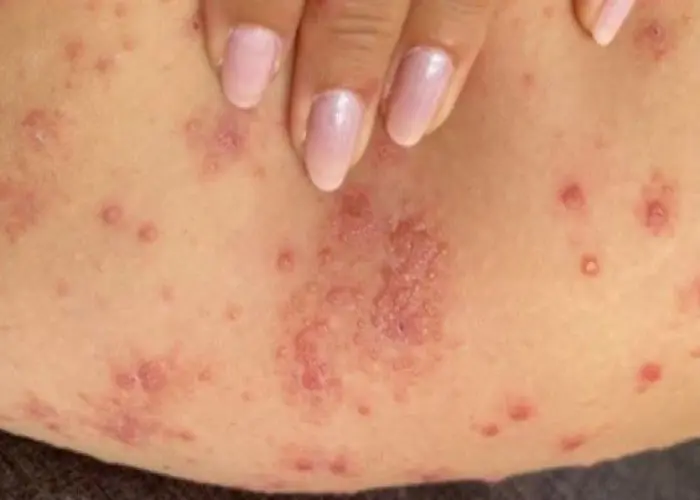 Chronic hives