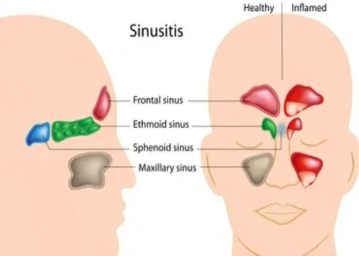 Chronic sinusitis