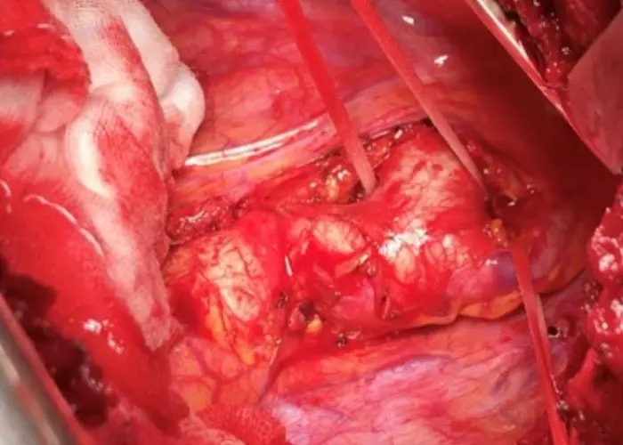 Coarctation of the aorta