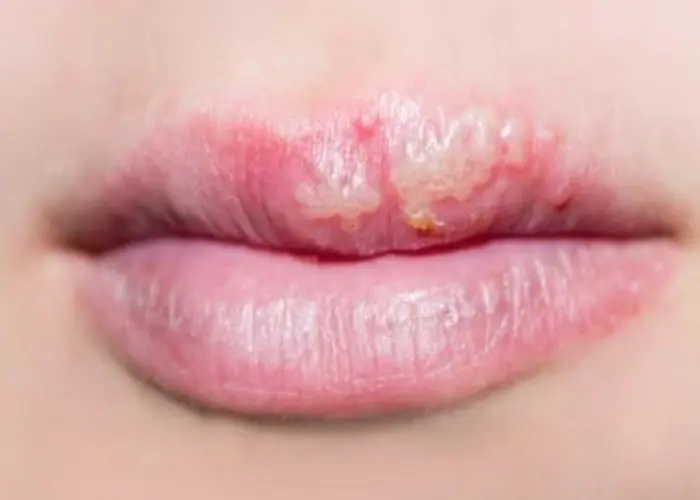 Cold sore