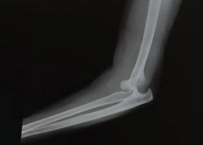 Dislocated elbow