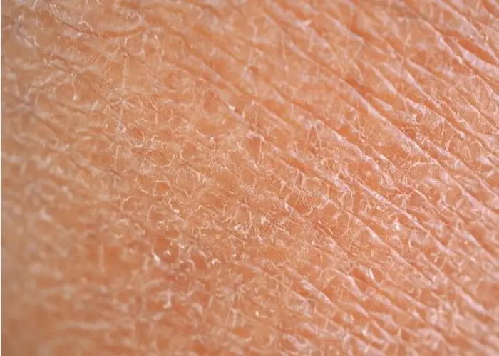 Dry skin