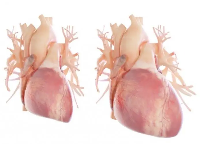 Enlarged heart