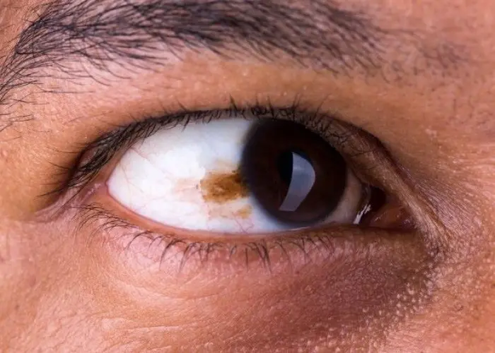 Eye melanoma