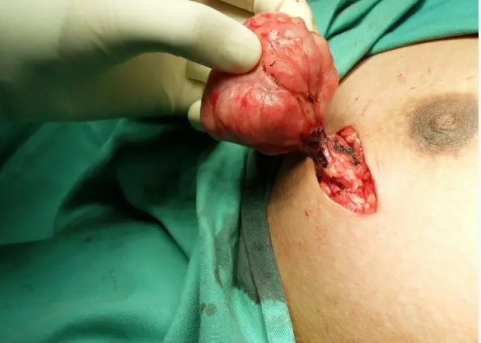 Fibroadenoma