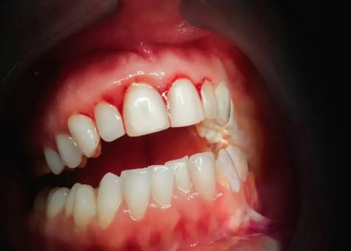 Gingivitis