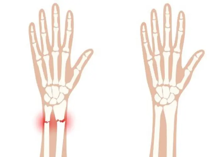 Greenstick fractures