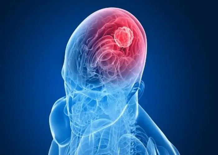 Head and neck cancers