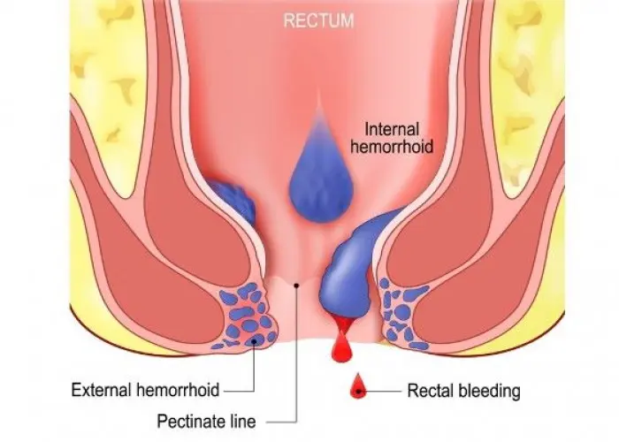 Hemorrhoids (Piles)