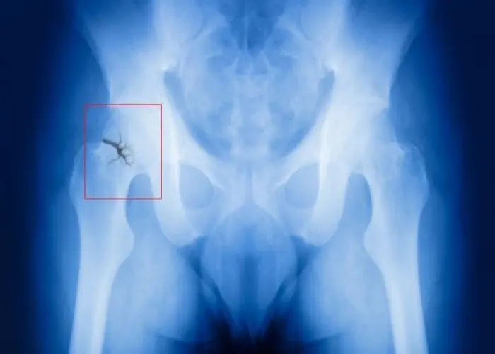 Hip fracture