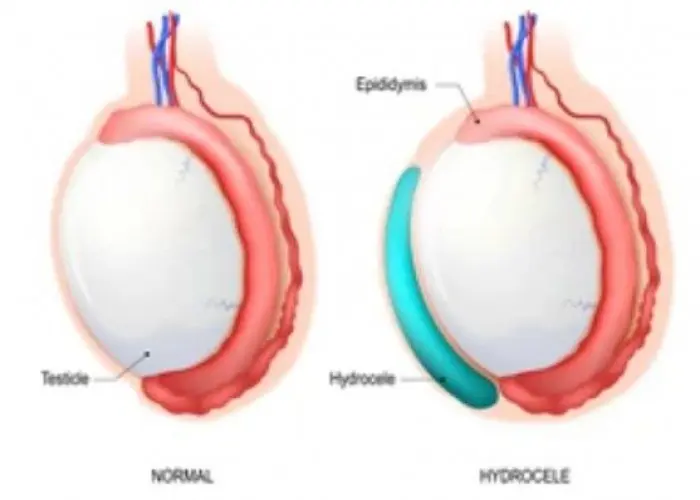 Hydrocele