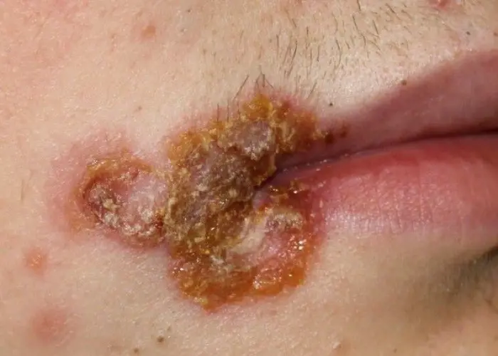 Impetigo