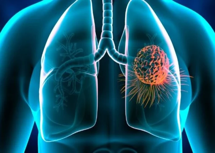 Lung cancer