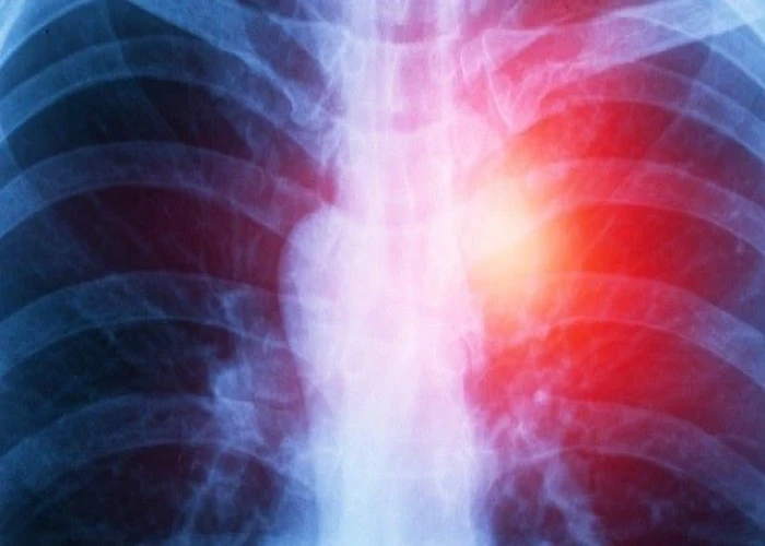 Mesothelioma